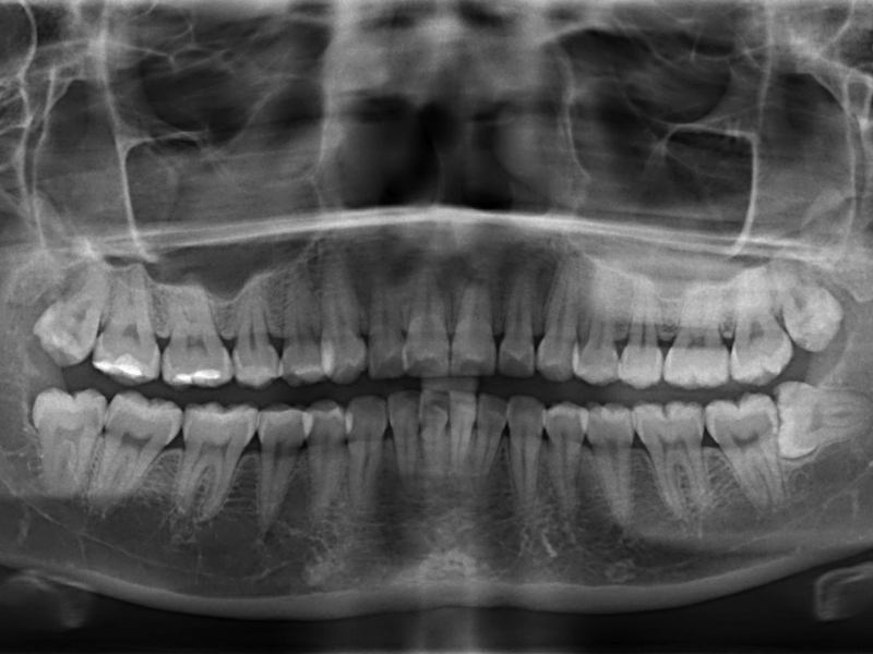 wisdom teeth (1)